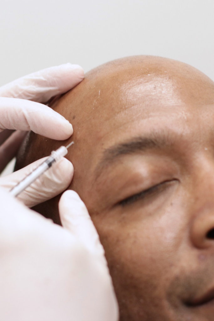 Botox injections 2- dermatolgist